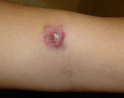 Illustration: Cutaneous lymphoma