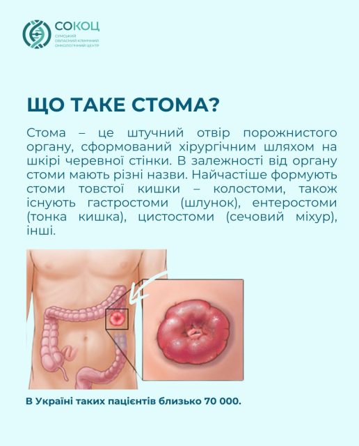 Ілюстрація до матеріалу: Всесвітній день стомованих хворих
